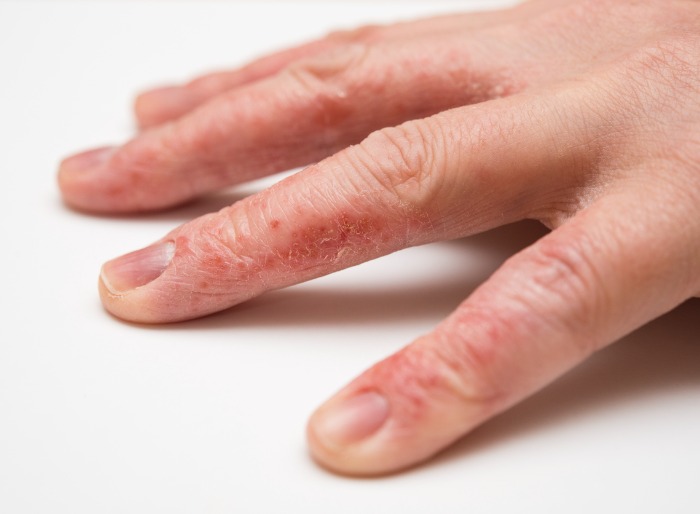 Eczema and Washing Hands Frequently